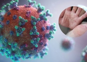 Confirman Casos de Virus Coxsackie en San Buenaventura Tecaltzingo